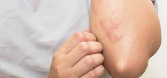 بیماری های پوستی مرتبط با ایدز (HIV)
